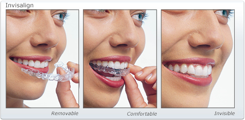 invisalign-auckland-treatment-dental